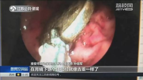 荒唐!宝宝误食硬币后家长不送医,竟然在家翻了18天大便