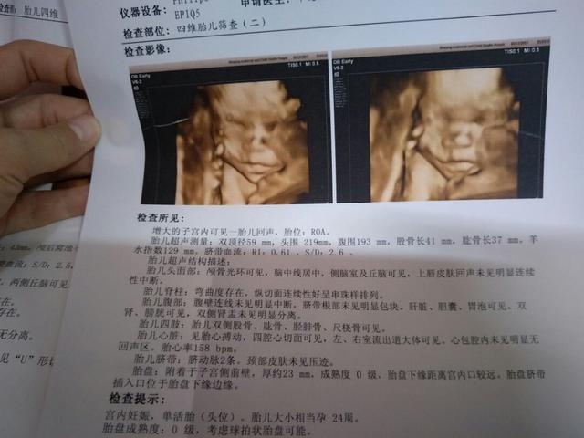 四维医生重复说宝宝脸大，得知真相，孕妈欣然一笑