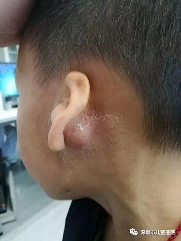 5岁男孩感冒发烧后,右耳后鼓起了红肿的小包!这是什么?