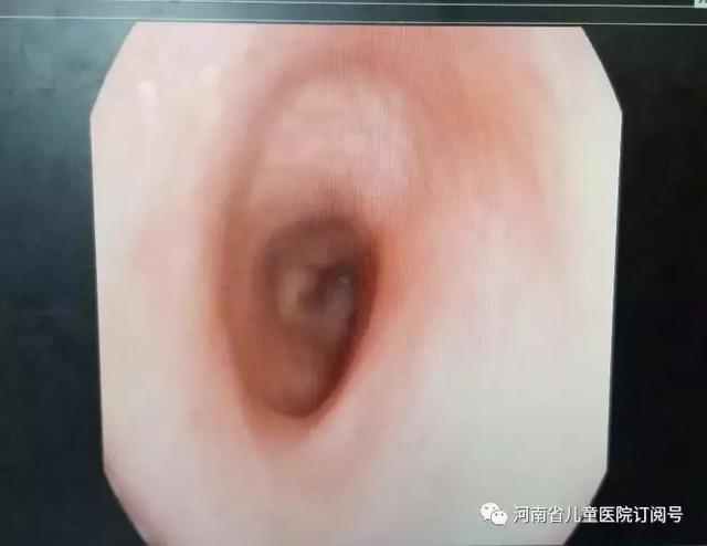 2岁宝宝腹泻反反复复，长达5个月之久！检查后发现是这“怪病”