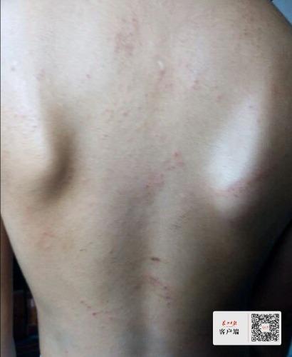 男童湿疹反复发作五年不见好，原是患上特异性皮炎