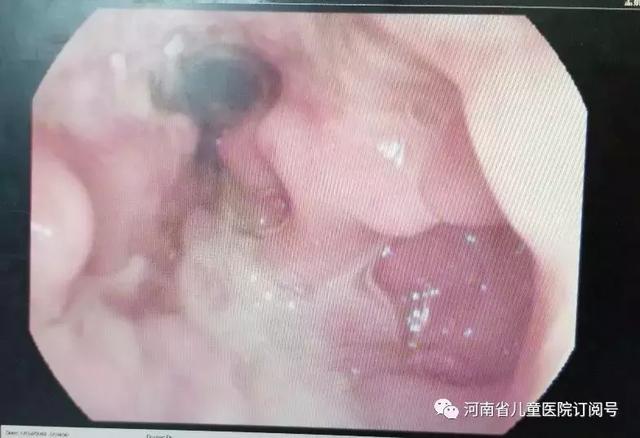 2岁宝宝腹泻反反复复，长达5个月之久！检查后发现是这“怪病”
