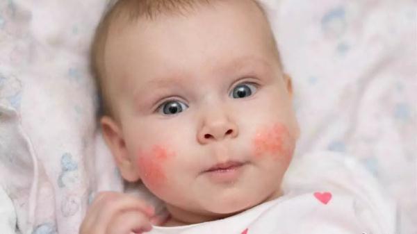 爸妈必看！孩子“苹果脸”的2个不良信号