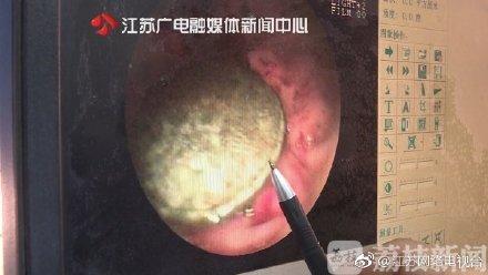 1岁半宝宝吞硬币 18天后取出来变成这样……