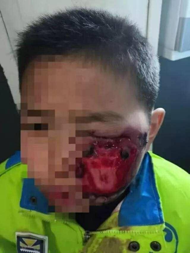 警惕！又有一孩子玩鞭炮被炸残！6点安全要诀要掌握