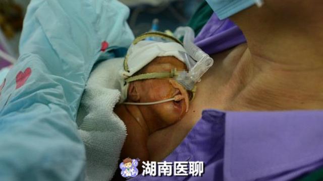早产儿呼吸微弱，体重仅2斤多，“袋鼠爸爸”用体温温暖宝宝