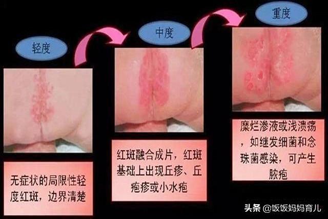 宝宝红屁屁多因这2种原因，5种预防方法2个妙招，值得妈妈学习！