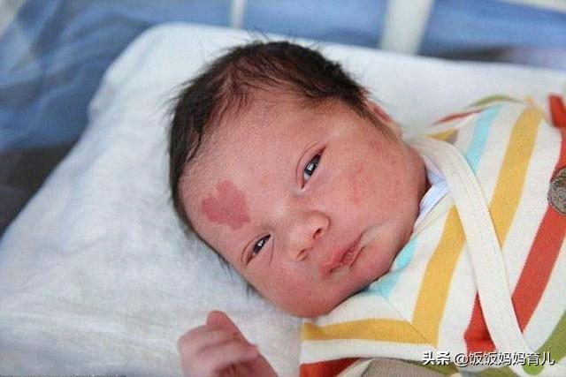 不想宝宝长胎记，孕期这4件事再忍不住也别做，颜值是一辈子的事