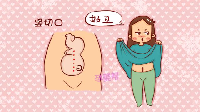 剖腹产“横切”和“竖切”有啥区别？产科医生：差异二胎会很明显