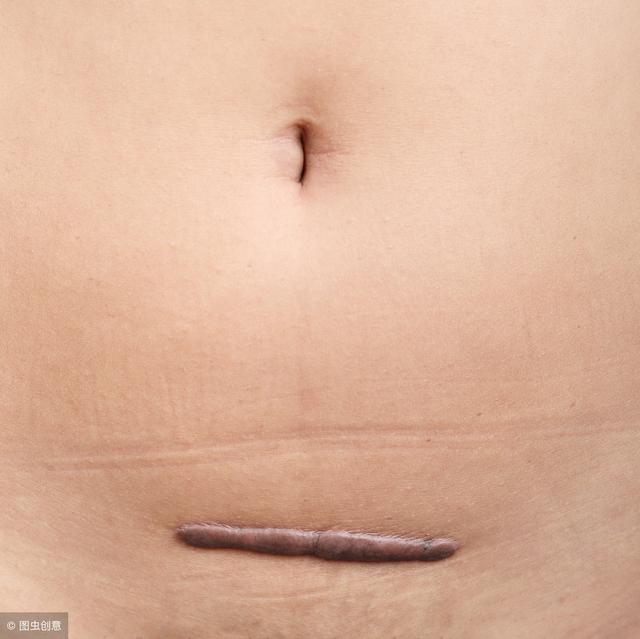 剖腹产横剖第三胎是什么感觉？三胎妈妈说：差点连小命都没保住
