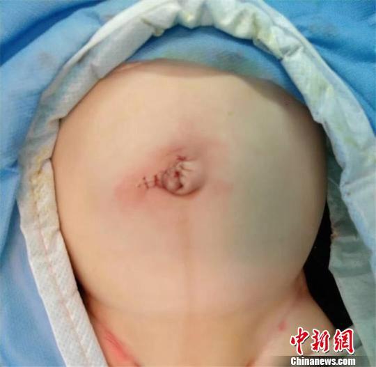 无知！1个月大婴儿肚脐外鼓 父亲竟一刀划开放气