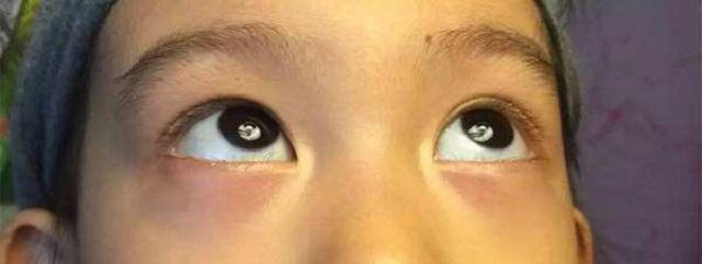 孩子眼袋有这颜色，说明脾胃差、爱生病！很多人却不知