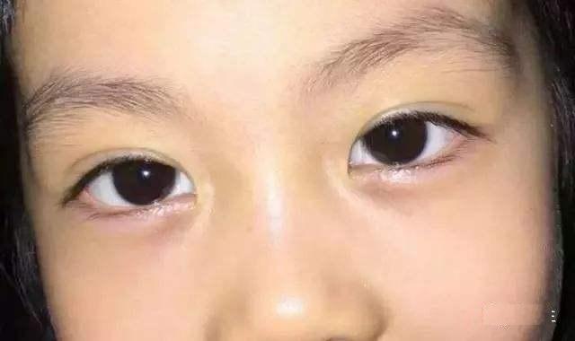 孩子眼袋有这颜色，说明脾胃差、爱生病！很多人却不知
