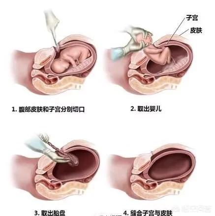 剖宫产中，横切口和竖切口有什么区别？