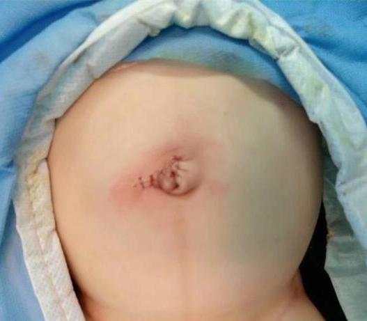 无知父母用刀片给宝宝放气，险让孩子丧命，科学育儿带你了解脐疝