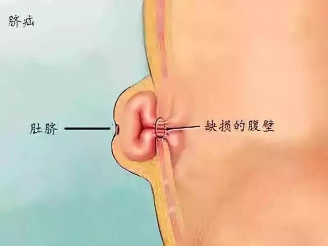 宝宝肚脐眼居然鼓出一个包？到底什么时候会好，要手术吗？