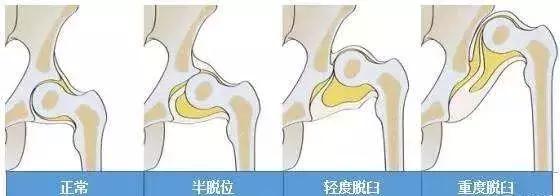 宝宝长短腿、跛行、走“鸭步”，或是这种骨病，早发现可不做手术