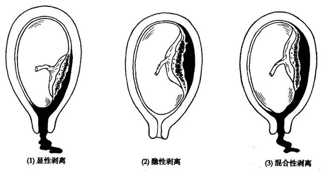 成功抢救胎盘早剥婴儿