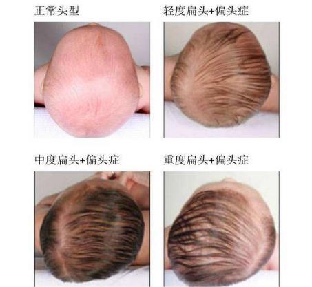 宝宝头型睡不好，影响头颅发育和颜值，家长做好2件事，有效改善