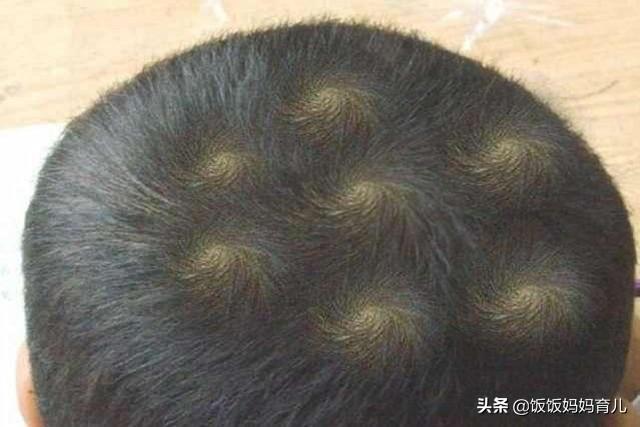 是什么导致孩子头“旋”个数不一样？很多家长不知道，你别不在意