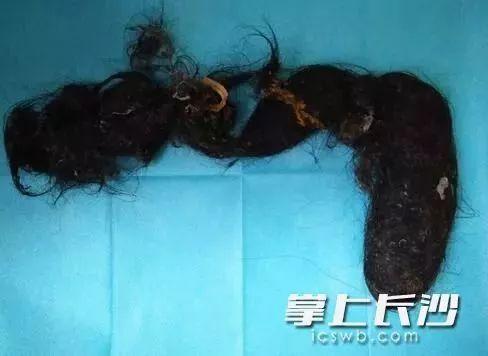 家长注意！9岁女孩老是呕吐还经常腹痛！竟是因为这个