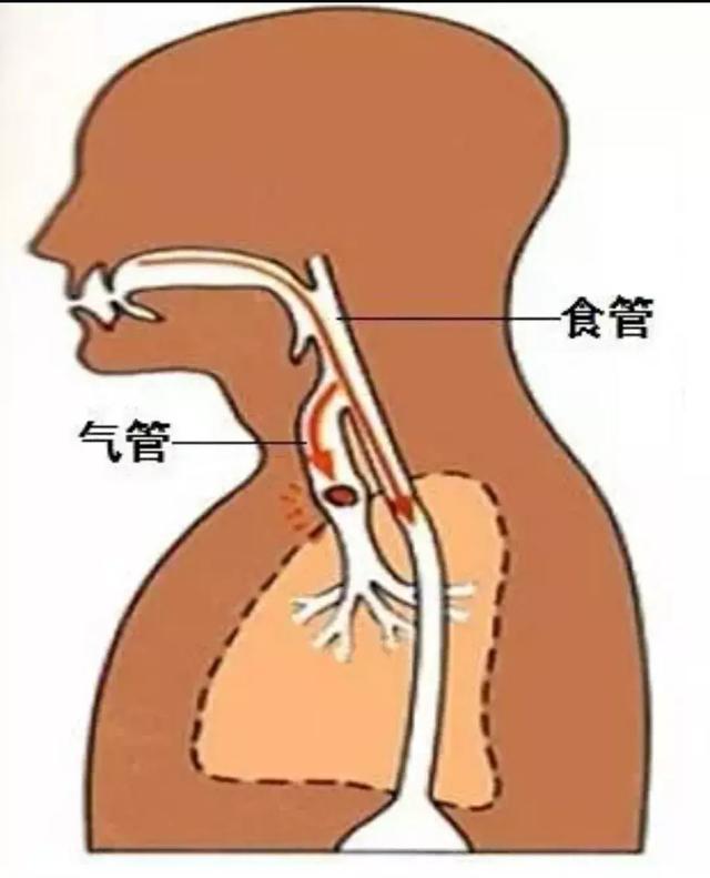 又一个孩子被噎身亡！这套能救命的方法一定要学会！