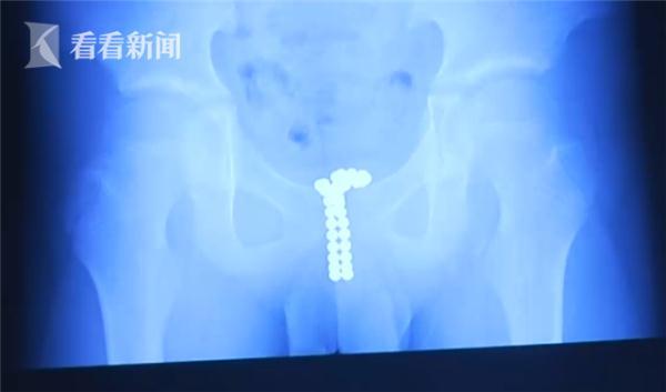 12岁男孩将39颗磁珠塞进尿道 自称全因为好奇……