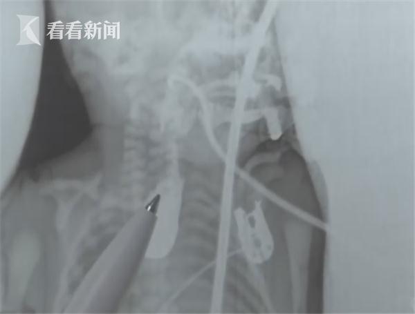 3斤多早产女婴吃不进奶 医生一查她食道竟是断的
