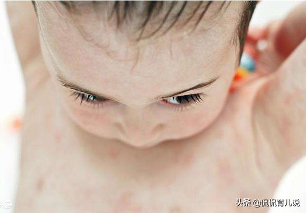天气转冷，孩子湿疹严重应该怎么办？宝妈：这些建议要熟记