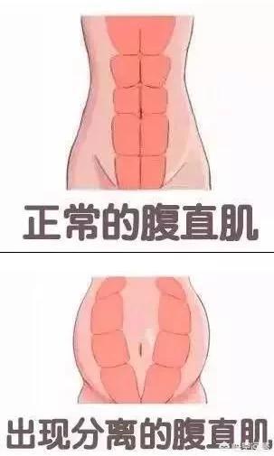 剖腹产后多久能穿收腹衣？如何护理伤口恢复比较快？