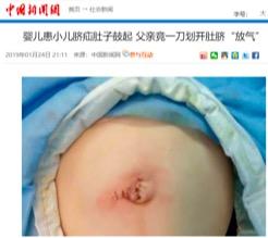 无知！婴儿患小儿脐疝肚子鼓起，父亲竟一刀划开放气