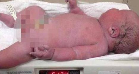 女子顺产生下一名12斤重巨婴，是普通婴儿的2倍大小