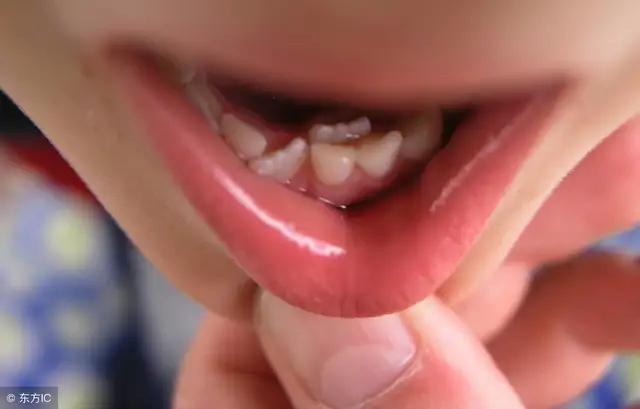 六七岁的孩子，今年进入“换牙季”！双排牙那些麻烦事，早知道！