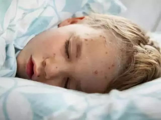 孩子皮肤出现小红疹是过敏还是水痘？一招教你识别