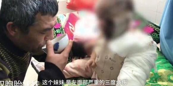 2岁双胞胎姐妹跌倒火炉旁，开水被打翻致姐妹俩严重烧伤