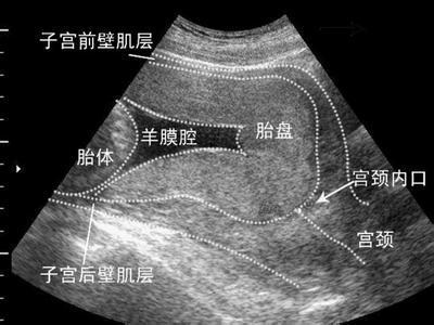 深夜产房：给植入性胎盘产妇接生，医生发现，胎盘碎在了子宫里