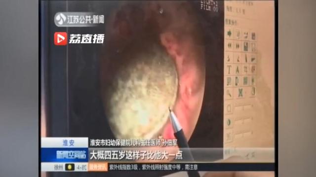 18个月的宝宝误吞硬币，胃部已被腐蚀，孩子吞食异物父母可别大意