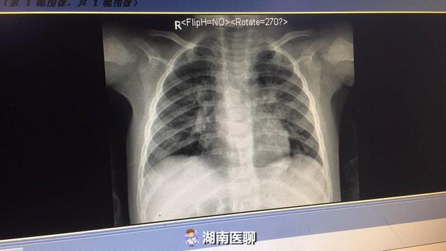 给肺“洗个澡”？9个月小宝宝反复咳嗽，检查发现肺中有“阴影”