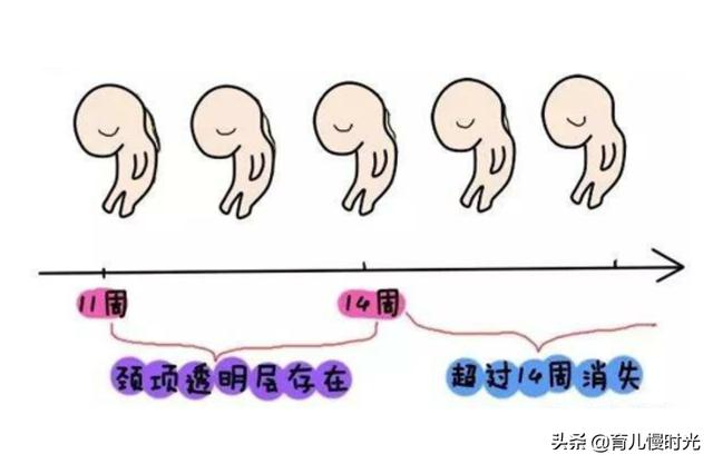 B超看唐氏综合征？NT，产检第一次排畸