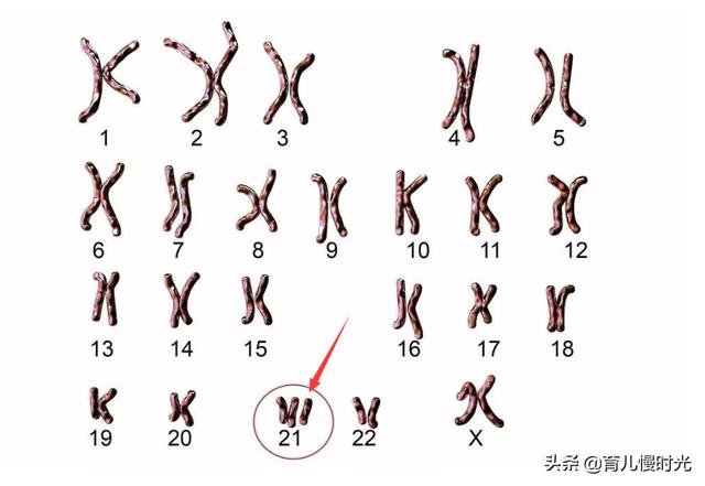 B超看唐氏综合征？NT，产检第一次排畸