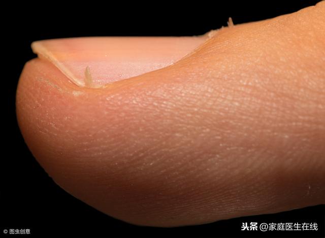 告诫父母：孩子手上长倒刺，一般是这3个原因导致