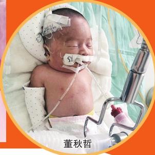 双胞胎器官发育不全 妈妈画幸运蛋祈福