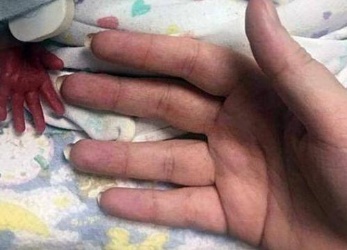 女婴早产3个月体重只有2斤多点，刚出生就被放塑料袋里保温