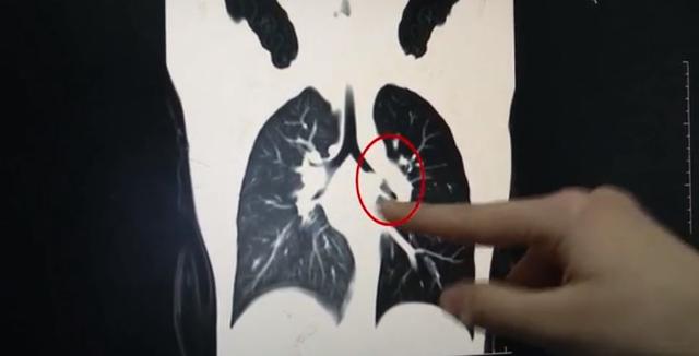 7岁男童咳了1年都没好，医生检查后，被他家长气坏了！