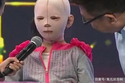 7岁女孩全身烧伤，多次进行整容手术，摘下面具后，看着让人心疼