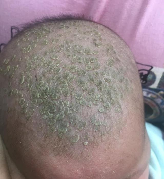 婴儿长绿头皮屑吓坏妈！医生提醒别乱抠