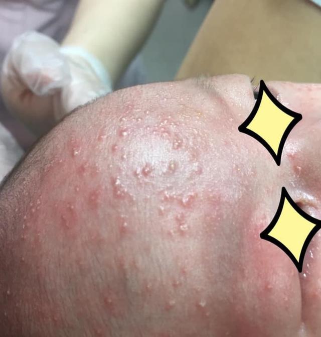 婴儿长绿头皮屑吓坏妈！医生提醒别乱抠