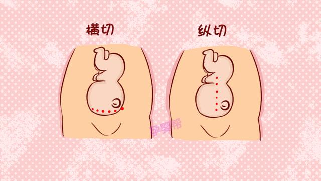 剖宫产疤痕一到雨天痛痒难忍？先别急着用手抓，这几种方法更有效