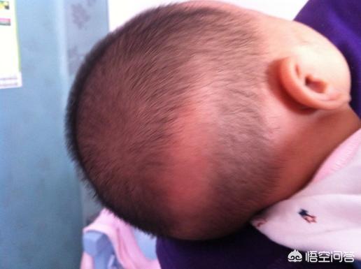 宝宝枕秃就是缺钙吗？医生终于说实话了
