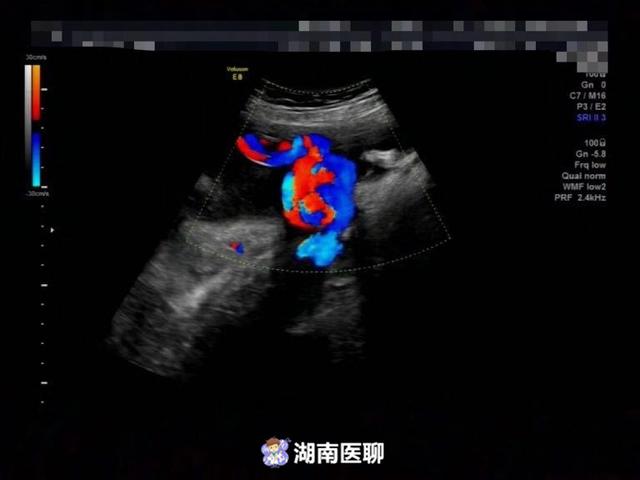 胎儿脐带成“中国结”？孕妇腹中宝宝险丧命，定期产检显“异常＂